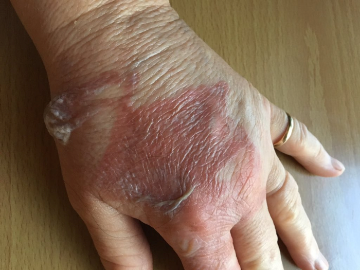 Burned Hand from Bacon Grease